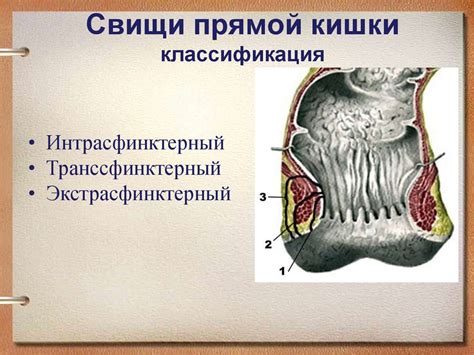 Заболевания прямой кишки (4 курс) - презентация онлайн