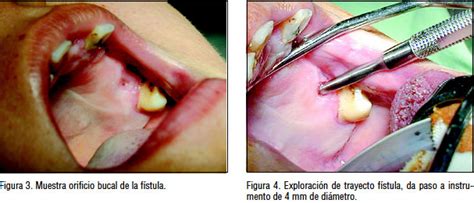 Cierre de fístula oroantral con injerto óseo y con rotación y avance de