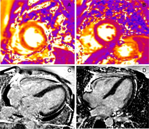 A Initial T2 Mapping Sequence In Short Axis View Showing Intense