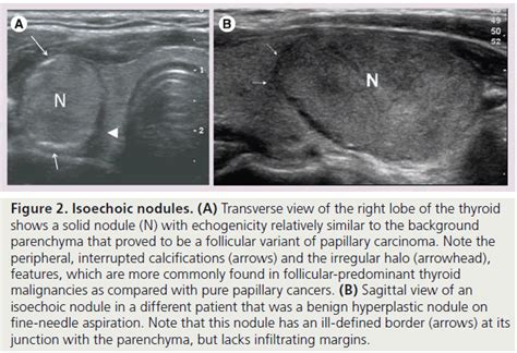 Thyroid Nodule Sonography Assessment For Risk Of Malignancy