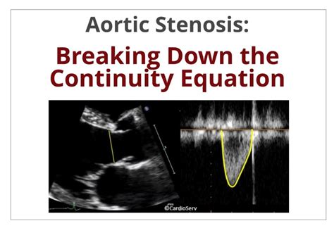 Aortic Stenosis Breaking Down The Continuity Equation Cardioserv