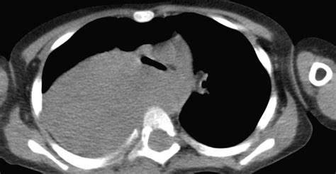 A Plain Axial Chest Computed Tomography Scan Showing A Large