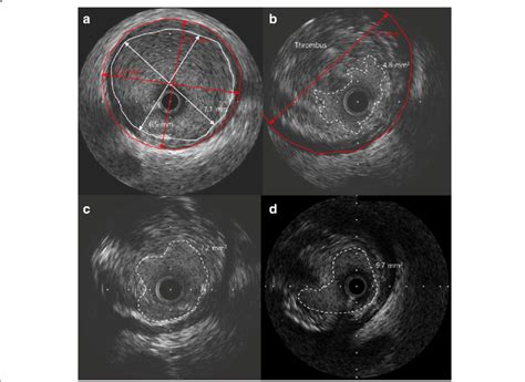 Intravascular Ultrasound IVUS Findings A Adjacent Normal Segment