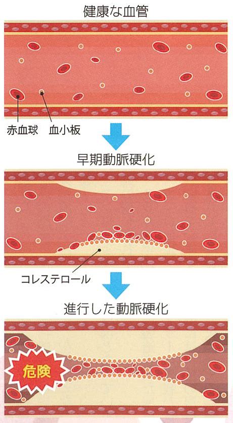 動脈硬化と血管年齢 富士森内科クリニック八王子の内科消化器科内視鏡内科循環器科リウマチ科小児科人間ドック 八王子市の内科