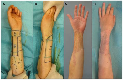 Multimodal Evaluation Of Donor Site Morbidity In Transgender Individuals After Phalloplasty With