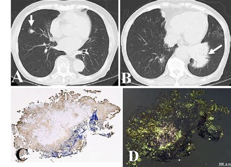 Pulmonary Amyloidosis Ct Of The Chest Shows A Small Nodule In The