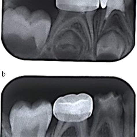 The 18 Month Periapical Radiographs In Two Patients After Partial