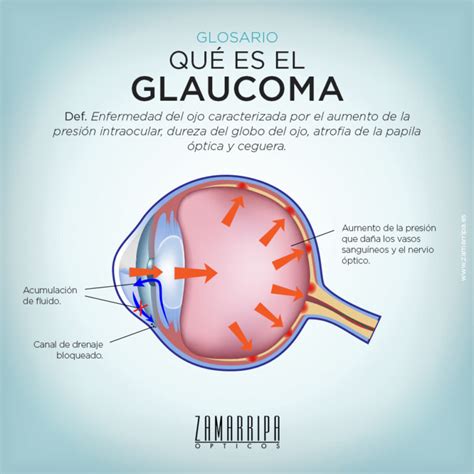 Tus Ojos Son Para Siempre ¡cuídalos Semana Mundial Del Glaucoma