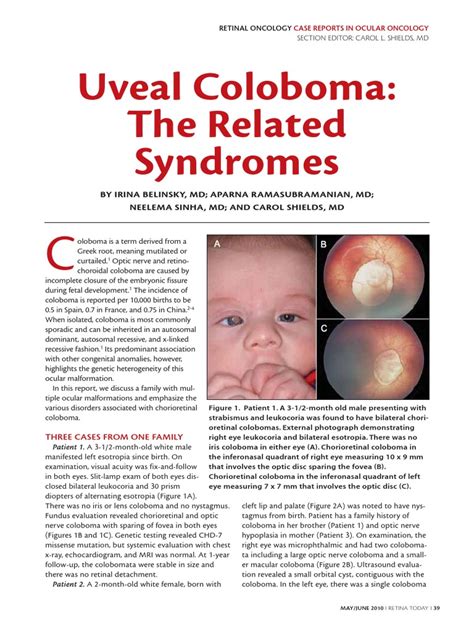 Uveal Coloboma The Related Syndromes Download Free Pdf Diseases Of The Eye And Adnexa