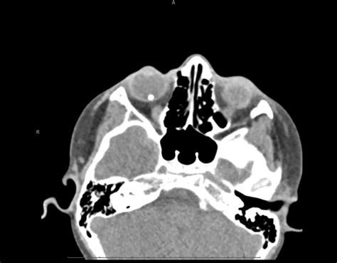 Open Globe With Intraocular Foreign Body Ct Axial Jetem 2019 Jetem