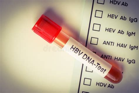 HBV DNA Test Test To Look For Abnormalities From Blood Stock Photo