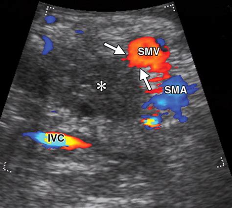 Intraoperative Ultrasonography Of The Pancreas Radiographics