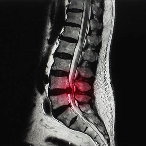 Spinal Stenosis | Treatment in Bangalore | Dr. Sampangi