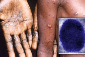 Monkeypox Case Of Rare Virus Confirmed In UK Signs And Symptoms