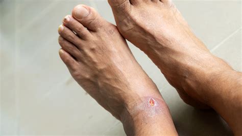 What Are Diabetic Foot Ulcers Causes Stages And Treatment Goodrx Atelier Yuwaciaojp