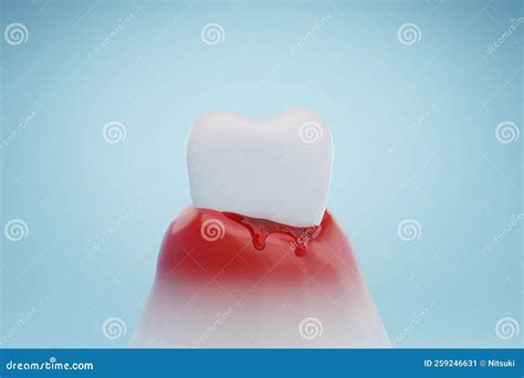 Gingival Bleeding Gum Bleeding Stock Photography Cartoondealer