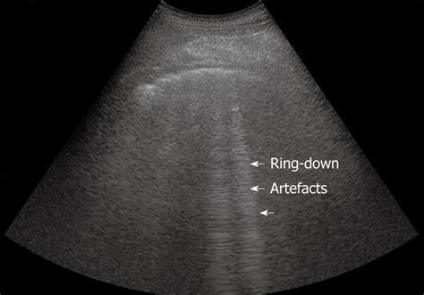 Emerging Roles For Transthoracic Ultrasonography In Pleuropulmonary Pathology