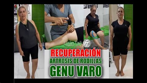 Artrosis De Rodillas Genu Varo Tratado En 3 Sesiones Fisioquiropraxia