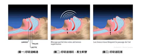 睡眠呼吸中止症 創智生技