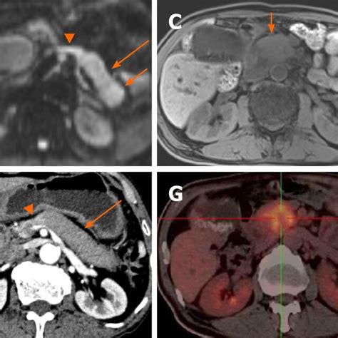 A 68 Year Old Man With Multifocal Autoimmune Pancreatitis A D Download Scientific Diagram