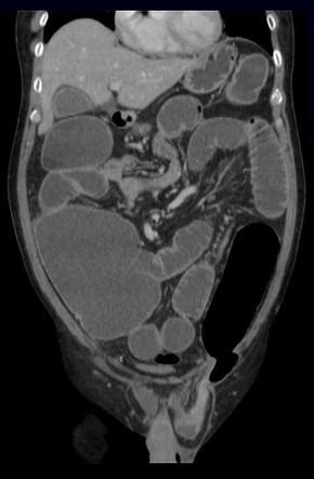 Indirect Inguinal Hernia Radiology Reference Article Radiopaedia Org