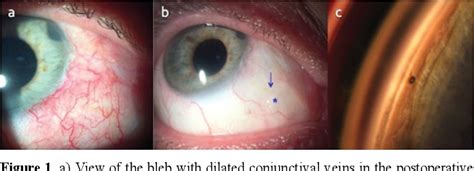 PDF Inferonasal XEN Gel Stent Implantation In A Refractory Glaucoma