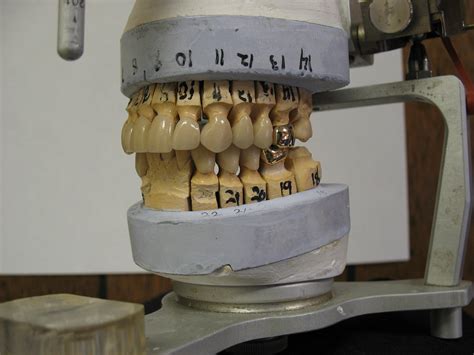 Bite Splint – FTI Dental Lab