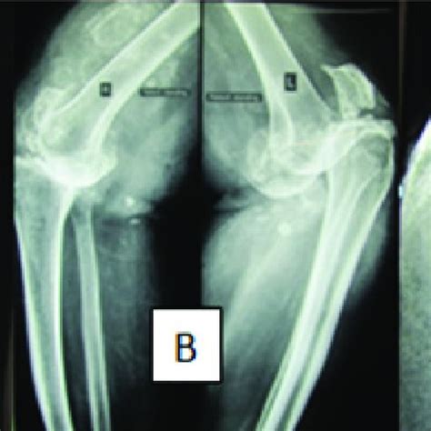 Equinus deformity, toes clawing and leg calf atrophy of lower extremities. | Download Scientific ...