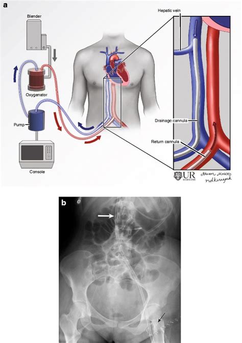 Illustration A And Radiograph B Demonstrating Peripheral Va Ecmo