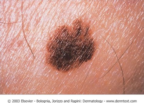 Melanoma What Is Melanoma In Situ