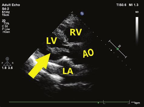 Postoperative First Month Transthoracic Echocardiography Parasternal