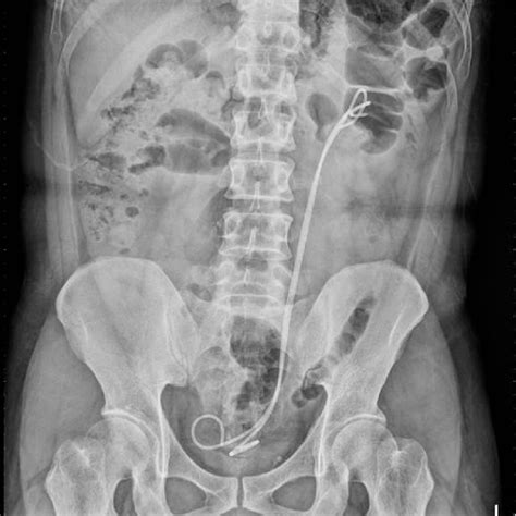 Plain Kidney Ureter And Bladder Radiograph Shows Two Double J Stents