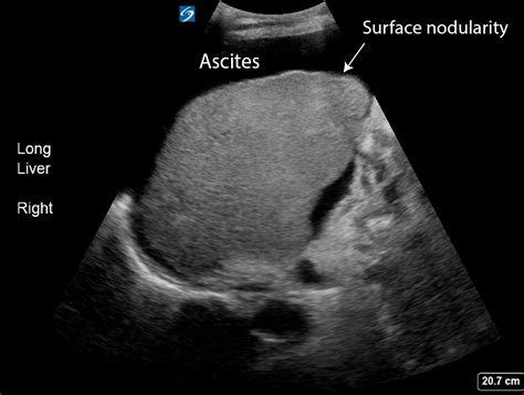 Alcoholic cirrhosis - Critical Care Sonography