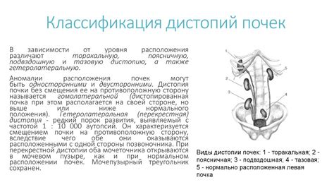 Дистопия почек - online presentation