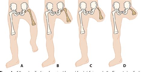 Figure 1 From Congenital Lower Limb Deficiencies In Finland Semantic Scholar