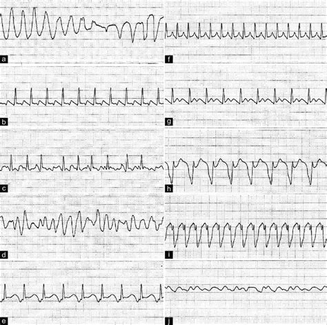 Atrial Flutter • Litfl • Ecg Library Diagnosis 48 Off