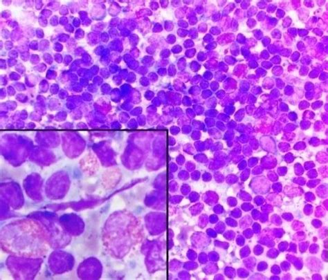 Fnac Smear Showing Eosinophilia Leishman Giemsa X 40 Inset X100