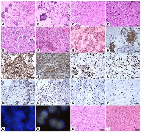 Histopathology And Immunohistochemistry Of Rosette Forming Glioneuronal