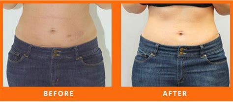 D Lipo Laser Toronto Weight Loss And Wellness Clinic