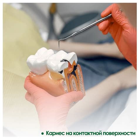 КАРИЕС НА КОНТАКТНОЙ ПОВЕРХНОСТИ Контактным кариесом называют кариозное ...