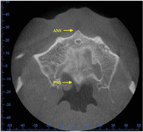 Relationship Between Maxillary Posterior Molar Roots And The Maxillary