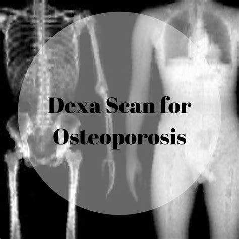 Dexa Scan For Osteoporosis Bump And Beyond Blog