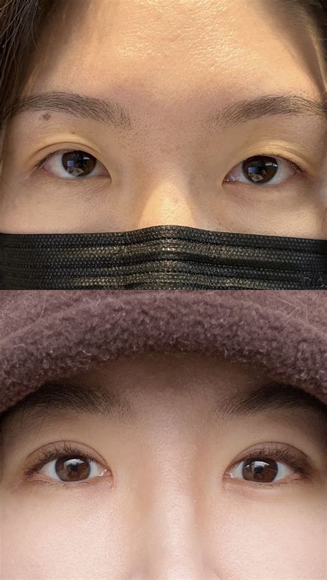 I Got Double Eyelid Surgery In Korea Here S Everything You Need To Know — Ahnest Kitchen