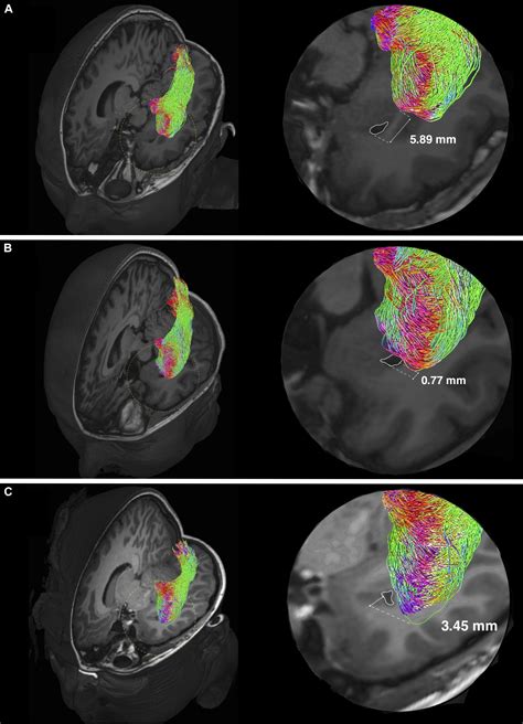 Frontiers Optic Radiation Tractography In Pediatric Brain Surgery Applications A Reliability