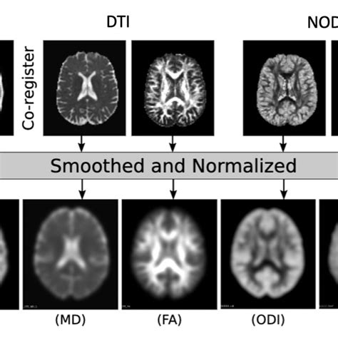 This Figure Depicts Two Mri Positive Focal Epilepsy Patients These Download Scientific Diagram