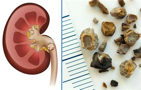 Colica Renala Si Litiaza Urinara De Ce Sunt Pietrele La Rinichi Atat