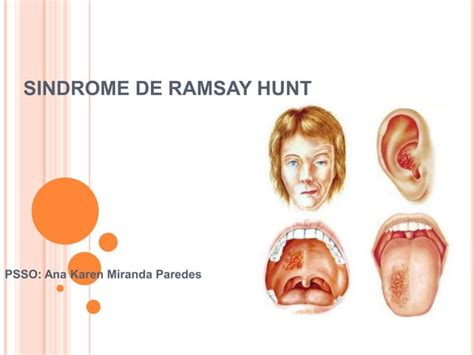 Sindrome Ramsay Hunt Ppt Descarga Gratuita