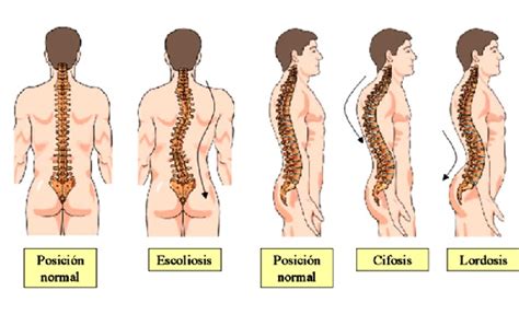 Enfermedades Que Afectan La Columna Vertebral Cuerpo Humano