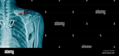 clavicle fracture x-ray image Stock Photo - Alamy