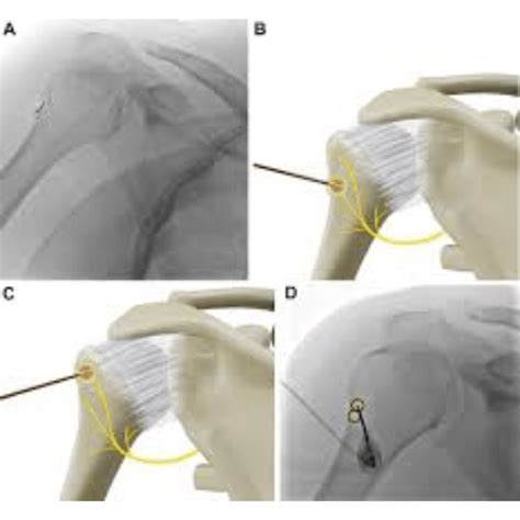 Cooled Radio Frequency Ablation For Knee Hip Pain Pune Dr Deshmukh S